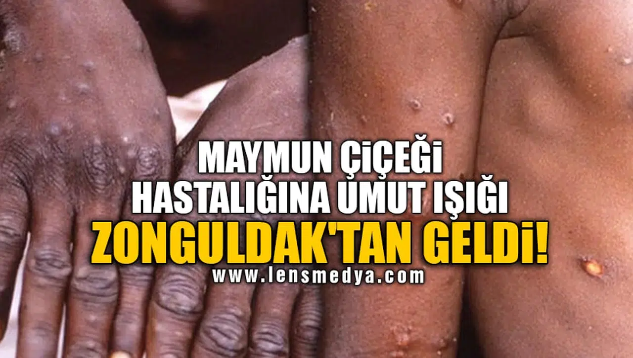 MAYMUN ÇİÇEĞİ HASTALIĞINA UMUT IŞIĞI ZONGULDAK'TAN GELDİ!