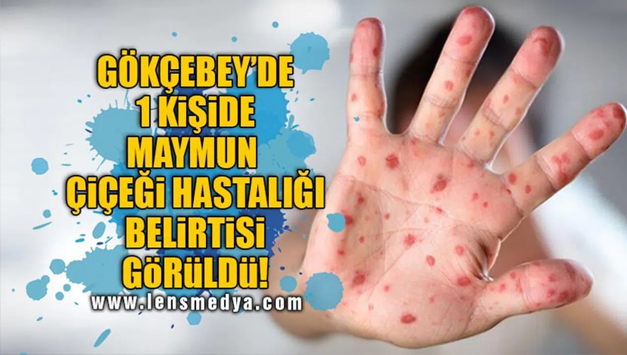 GÖKÇEBEY'DE 1 KİŞİDE MAYMUN ÇİÇEĞİ HASTALIĞI BELİRTİSİ GÖRÜLDÜ!